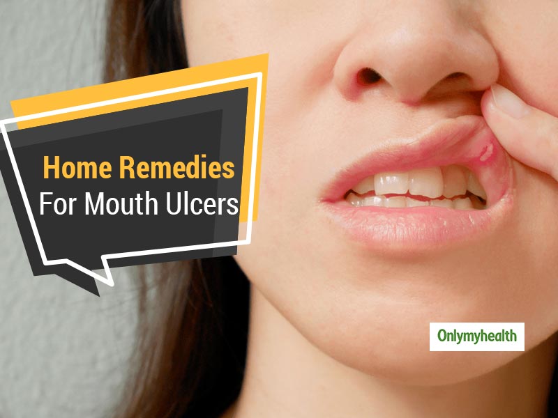 troubled-due-to-mouth-ulcers-get-respite-with-these-home-remedies